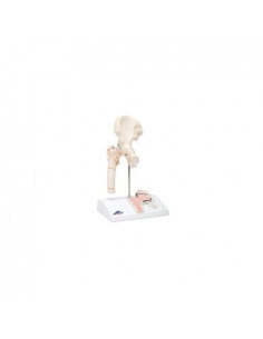 Fracture du fémur et...