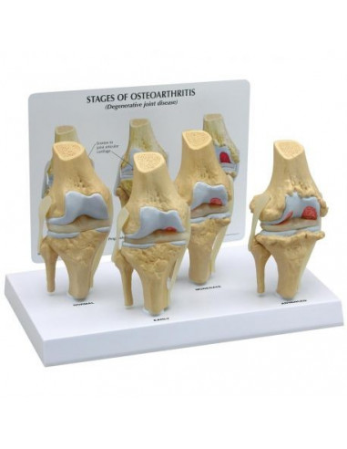 Stades d'ostéoarthrite de l'articulation du genou (4 stades) 3B Scientific 1019502