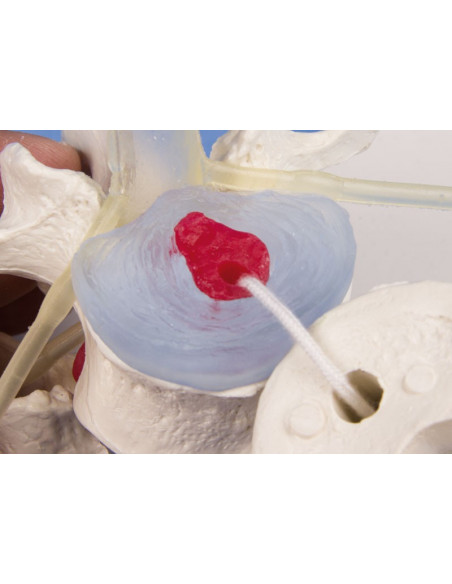 Erler Zimmer modèle anatomique didactique de 3 vertèbres lombaires avec prolapsus, sur support 4047