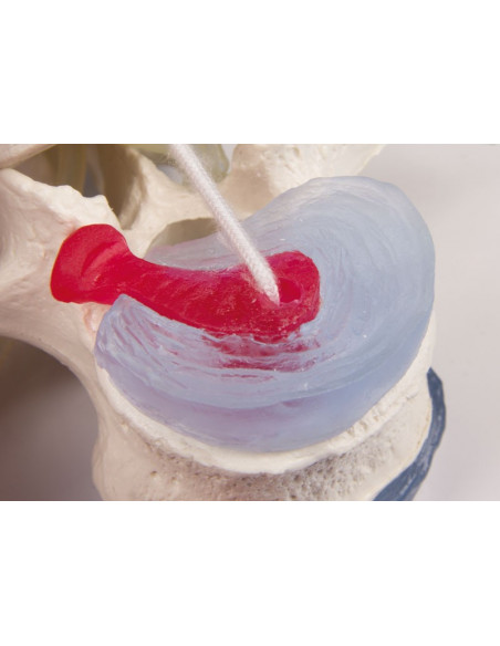 Erler Zimmer modèle anatomique didactique de 3 vertèbres lombaires avec prolapsus, sur support 4047