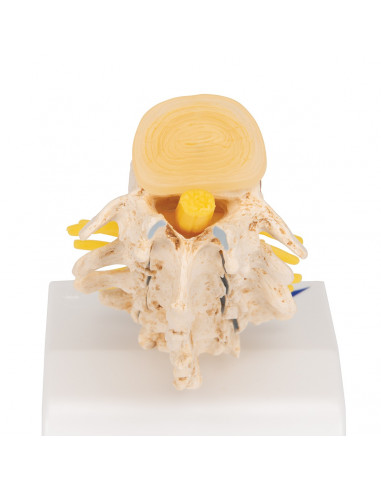3B Scientific, Stadi dell'ernia del...