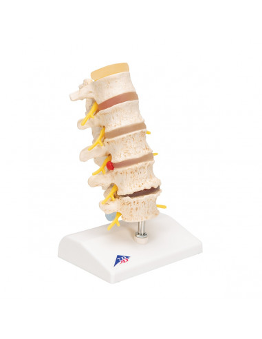 3B Scientific, Stadi dell'ernia del...