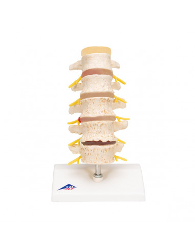 3B Scientific, Stadi dell'ernia del...