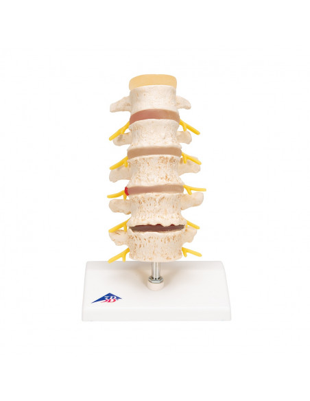 3B Scientific, Stadi dell'ernia del disco intervertebrale e degenerazione della vertebra A795