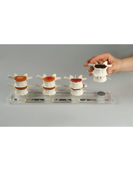 Erler Zimmer, modèle anatomique des phases de dégénérescence du disque intervertébral, en 4 parties 7577