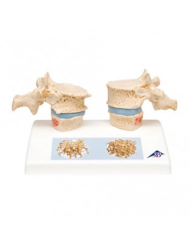 3B Scientific, modèle d’ostéoporose A95
